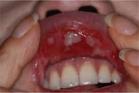 입안 염증이 생기는 이유