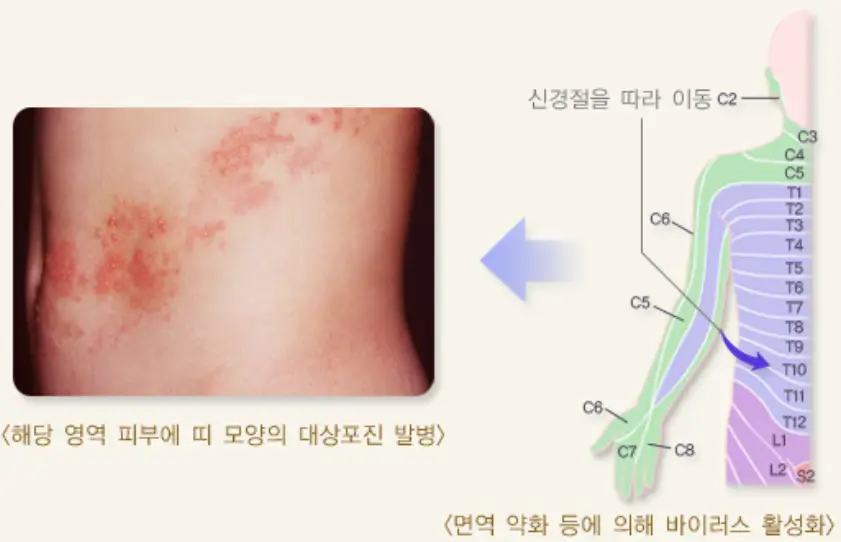 대상포진-발병진행-이미지