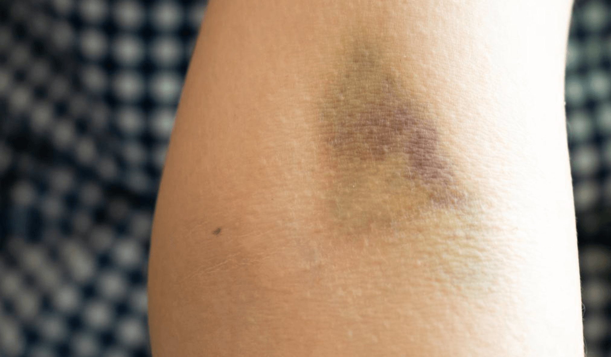 태반주사 부작용