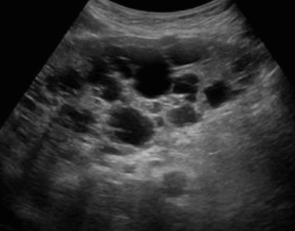 polycystic liver disease