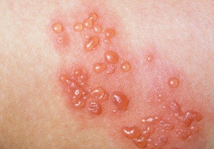 대상포진-초기증상-피부