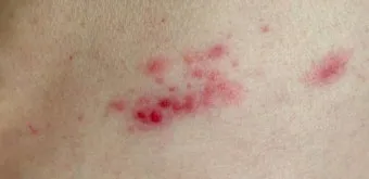 경기도 대상포진 무료접종 연령 기준 정리로 안내_19