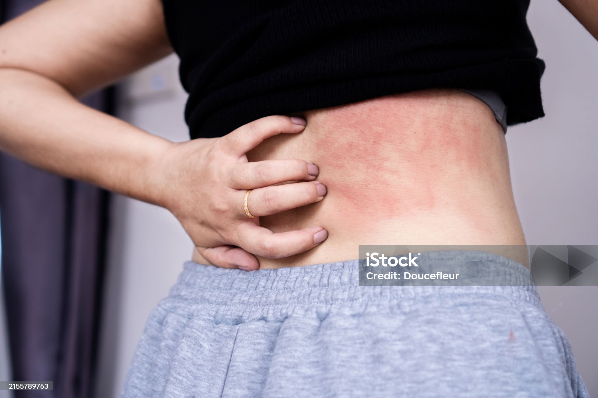 아토피성피부염-관련-사진