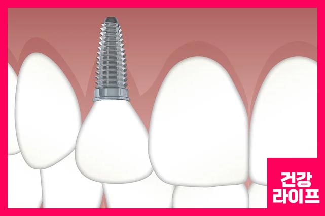 임플란트 치료 계획하기