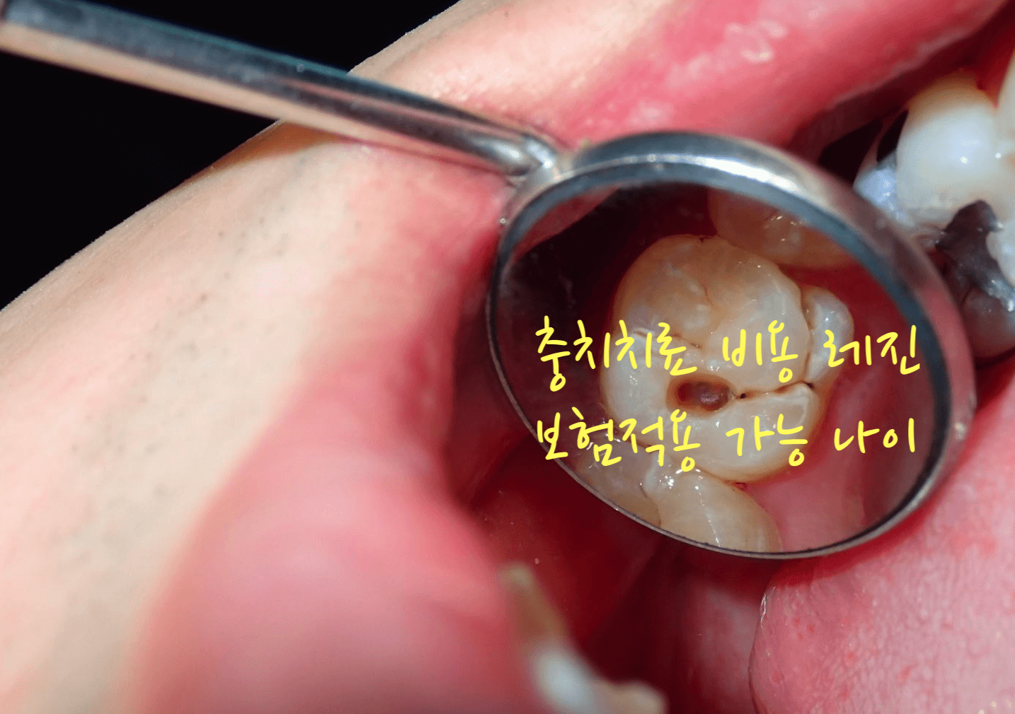 충치치료