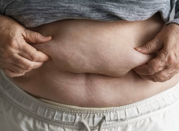 급격한 체중 감량 후 늘어진 피부, 탄력 회복 방법과 관리 팁 완벽 가이드