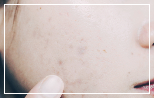 마데카크림-부작용