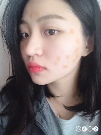 얼굴 비립종 없애는 법 자극 없이 제거하는 피부관리법_17