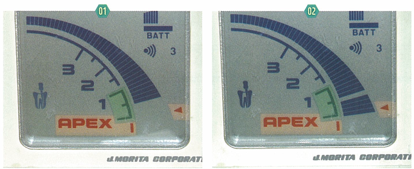근관장 측정방법