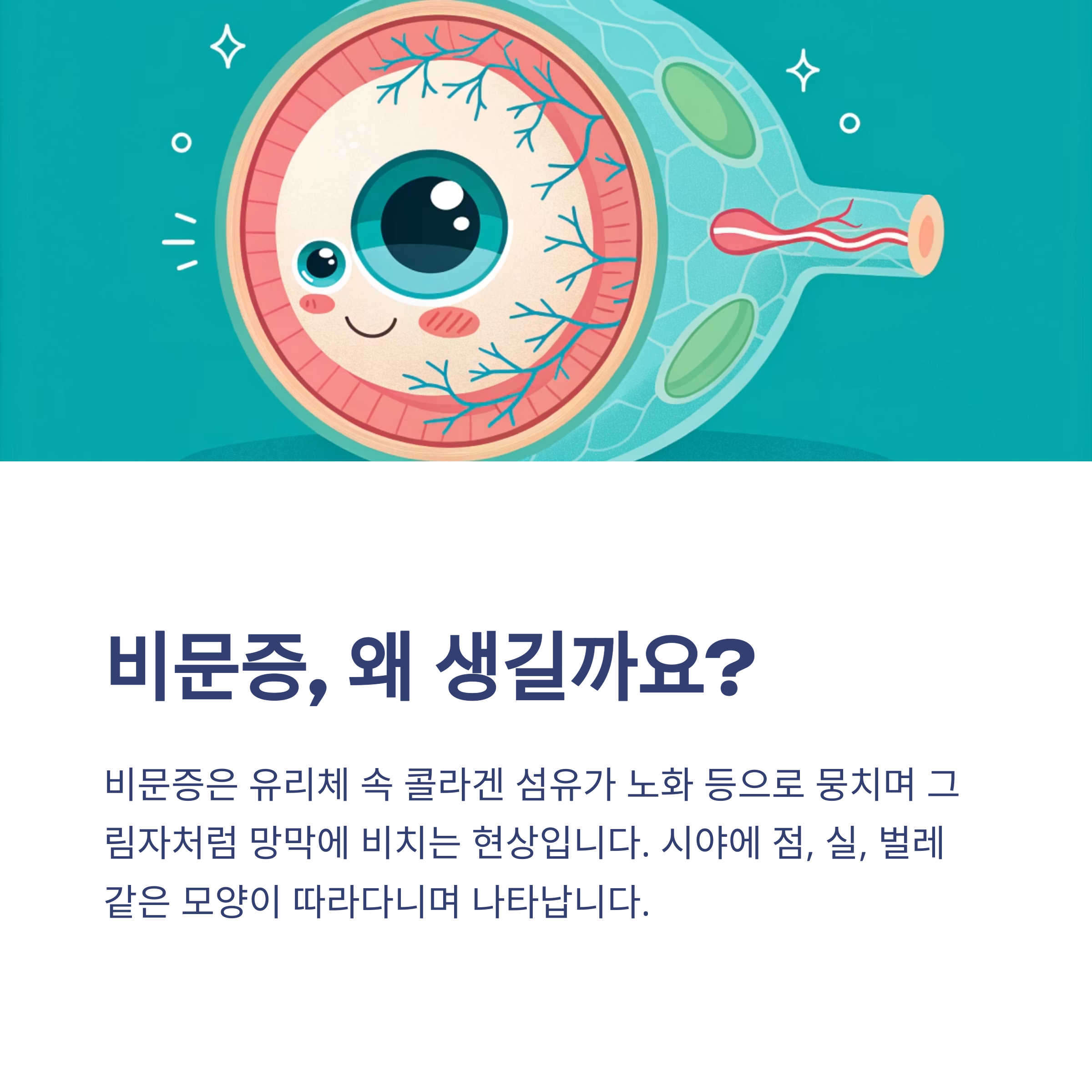 비문증, 왜 생길까요?