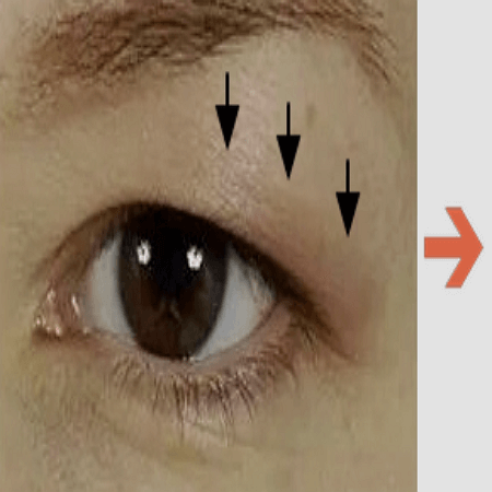 눈썹거상술 전 모습 후기