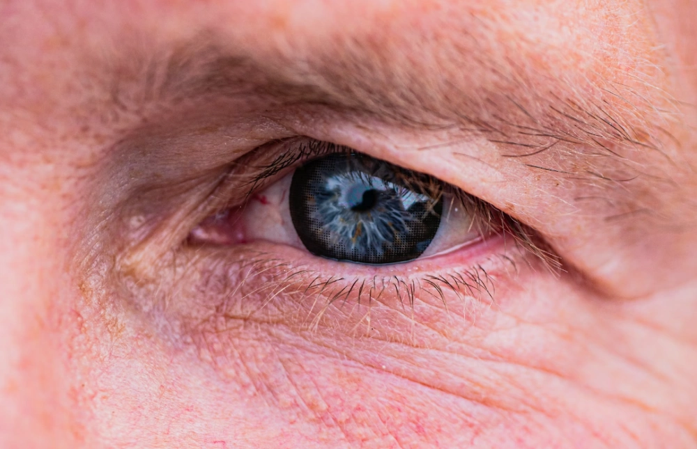 후발성 백내장 원인