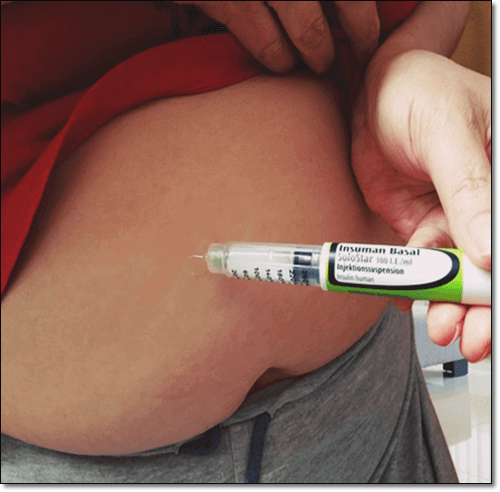 괴사성 급성 췌장염 합병증