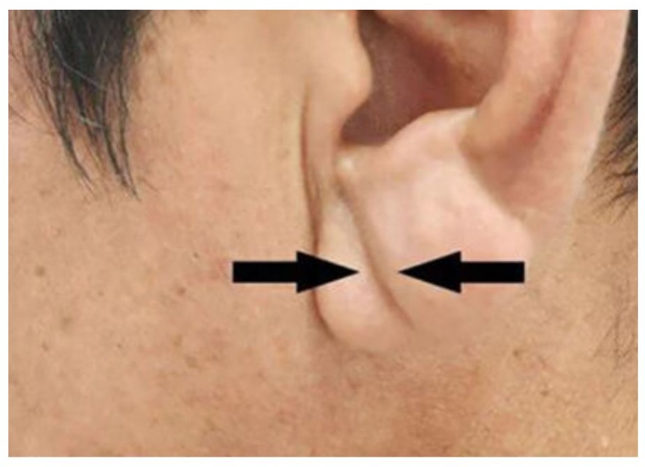 귓불에 주름 이미지