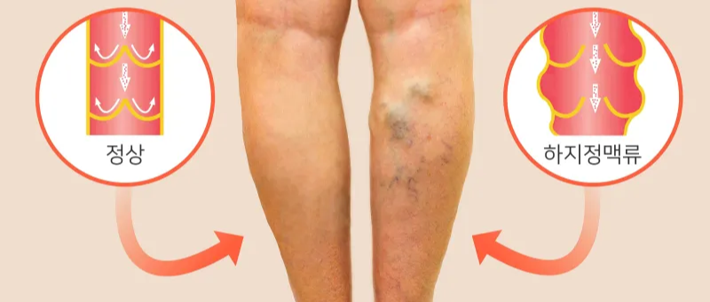 하지정맥류