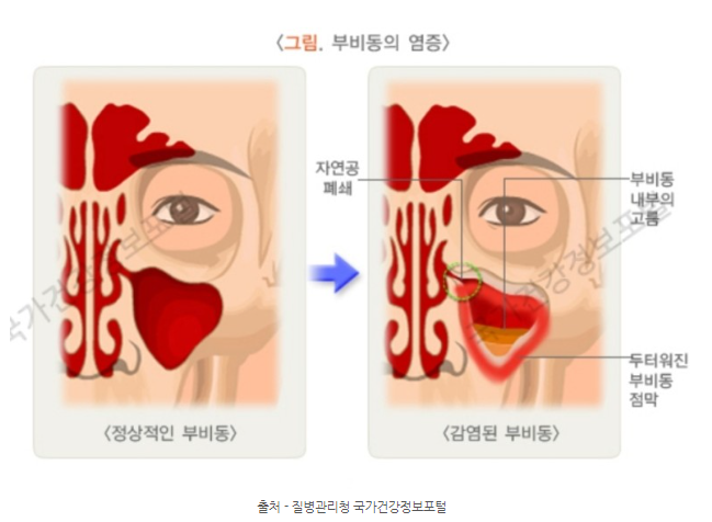 부비동염