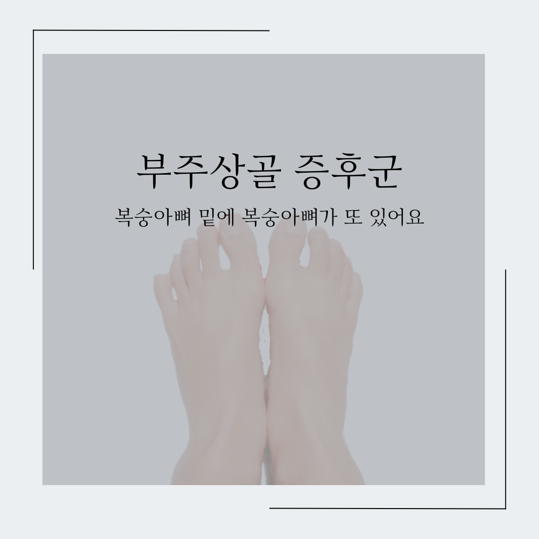 부주상골 증후군