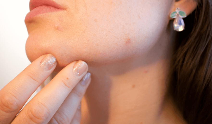 몸이 붓는 원인으로 여성 호르몬 과다 분출로 인하여 얼굴에 여드름이 생긴 여자