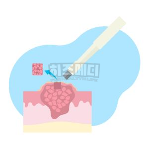 위내시경 전날 음식 금식시간