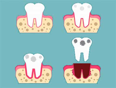 잇몸-염증-치주염