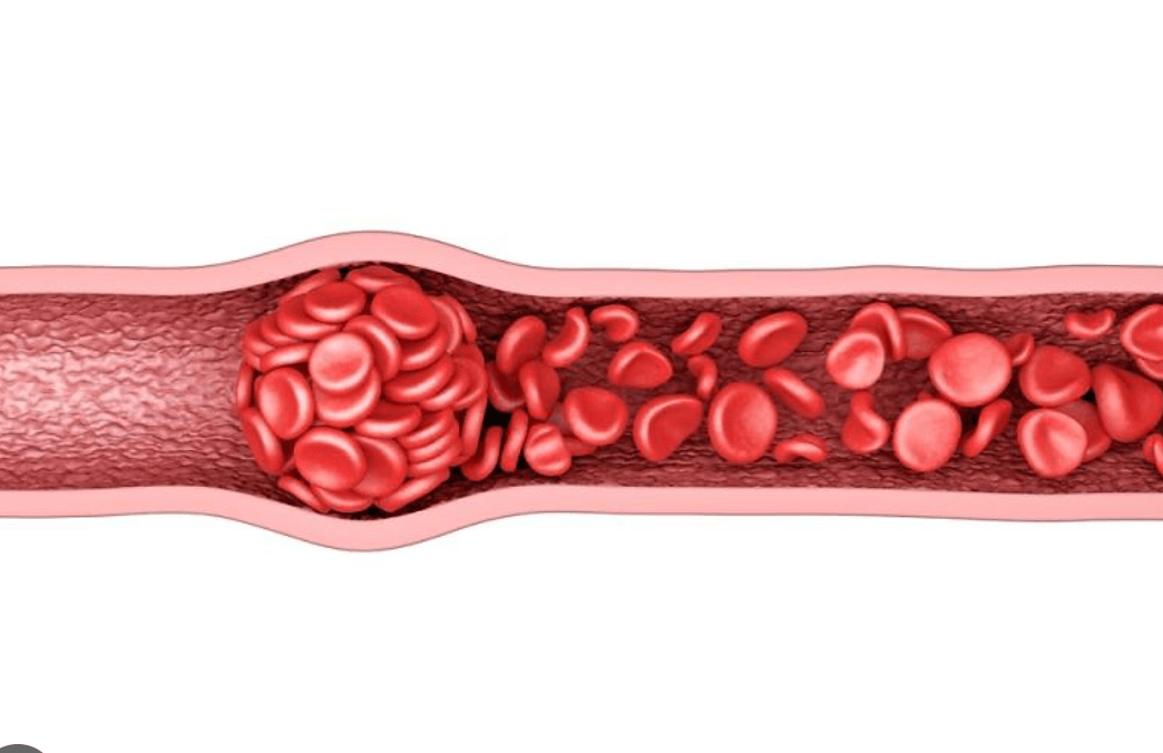혈관에 혈전이 발생한 모습