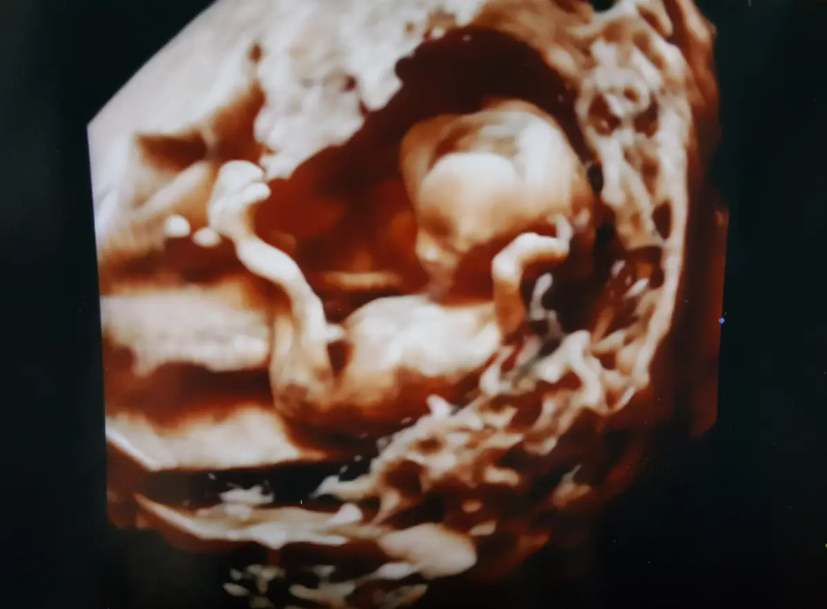 초기 정밀 초음파 사진