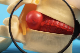 허리통증 치료사진