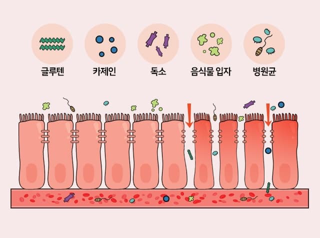 자가면역질환과 장 건강의 관계, 장누수증후군