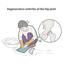 퇴행성 관절염 인공관절 수술