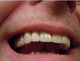 이빨 빠지는 꿈