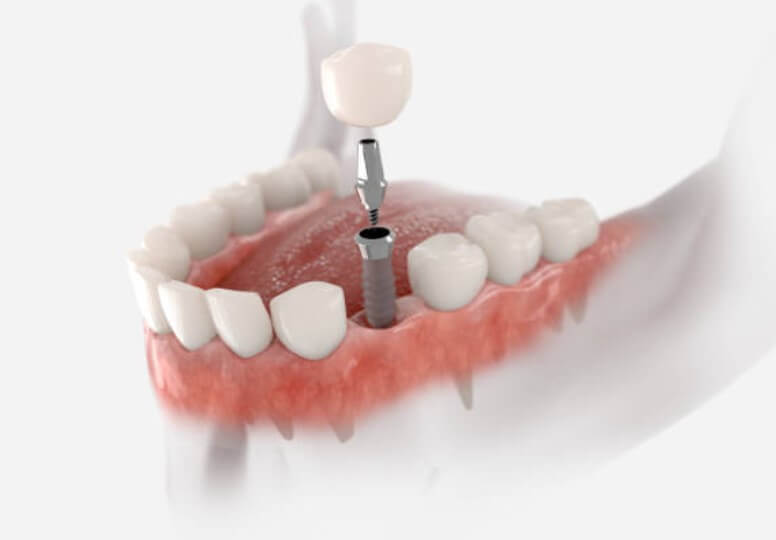 임플란트 시술기간