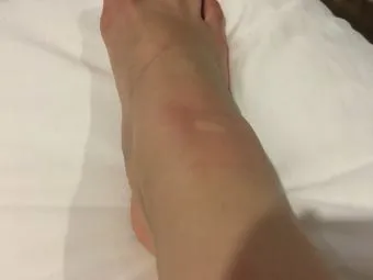 모기 물려 가려울 때 땀띠에 안티푸라민 연고 효능 부작용 사용후기_12