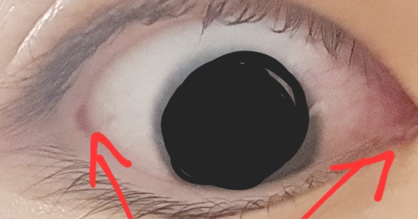 콘서타 고혈압 수치 상승 부작용으로 눈에 실핏줄이 빨갛게 터진 모습