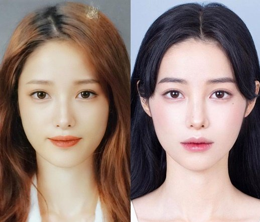 유깻잎 성형 전 후