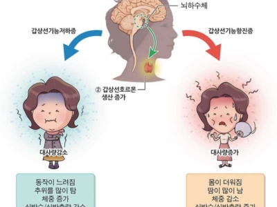 갑상선 이미지