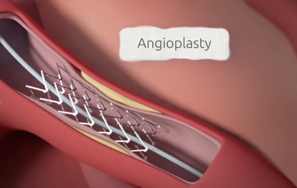 관상동맥 조영술