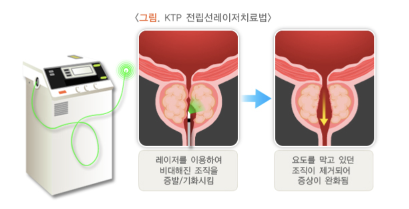 kTP 전립선레이저치료법