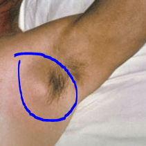 흑사병으로 인한 림프 부종