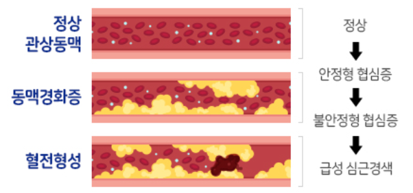 협심증-심근경색-차이-관상동맥-중재술-명의