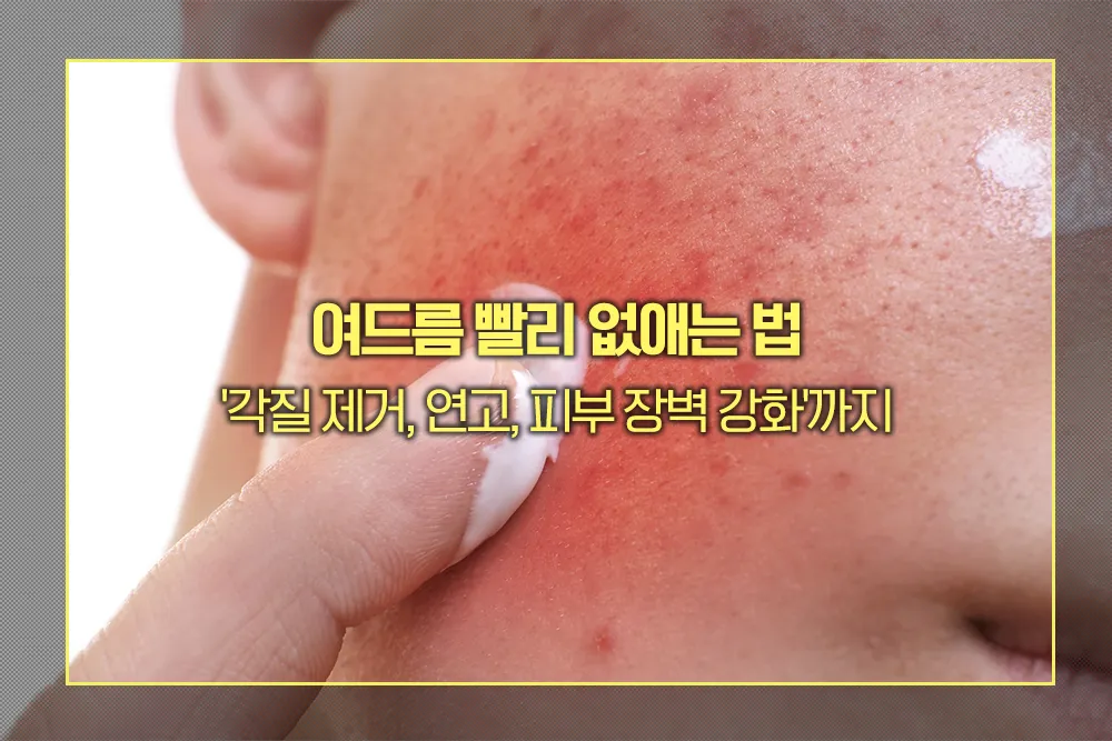 여드름 빨리 없애는 법