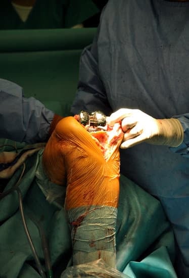 무릎 관절염의 수술적 치료 방법