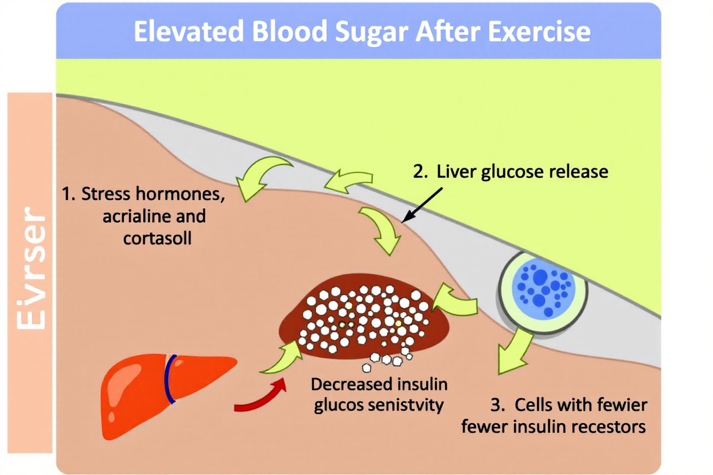 "운동 후 혈당 상승의 생리적 원인 요약 다이어그램: 스트레스 호르몬, 간 포도당 방출 등"