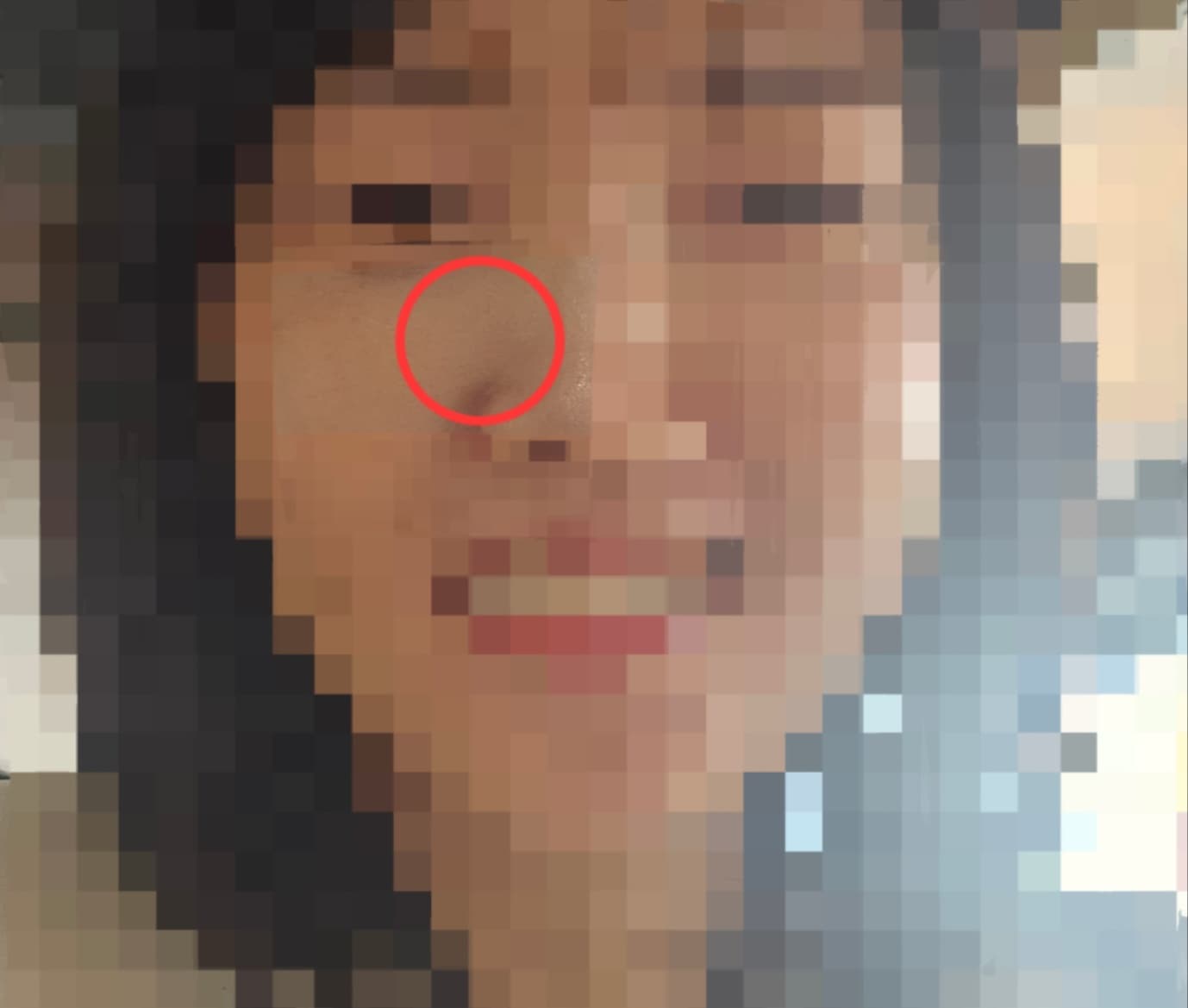 뾰루지를 짰는데 얼굴에 구멍이 생겼어요(위너확장구멍 없애기)