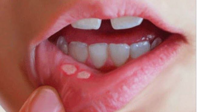 입안에 구내염이 생긴 모습