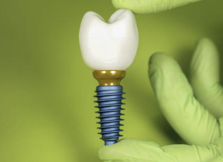 임플란트 가격 확인 최저가 확인 시술기간 (최신)