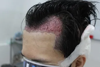 머리카락 이식 3000모 3000모낭 비용과 시술 과정_8
