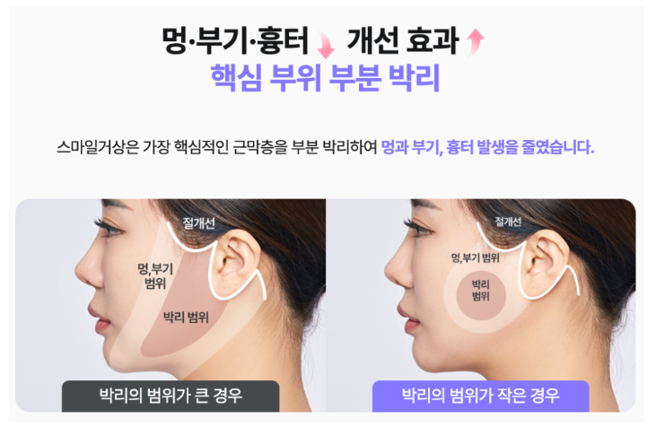 강남역성형외과 스마일거상