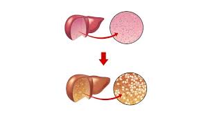 지방간 없애는 방법