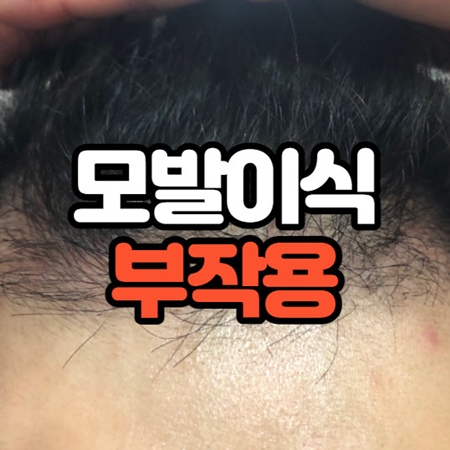 모발이식 부작용
