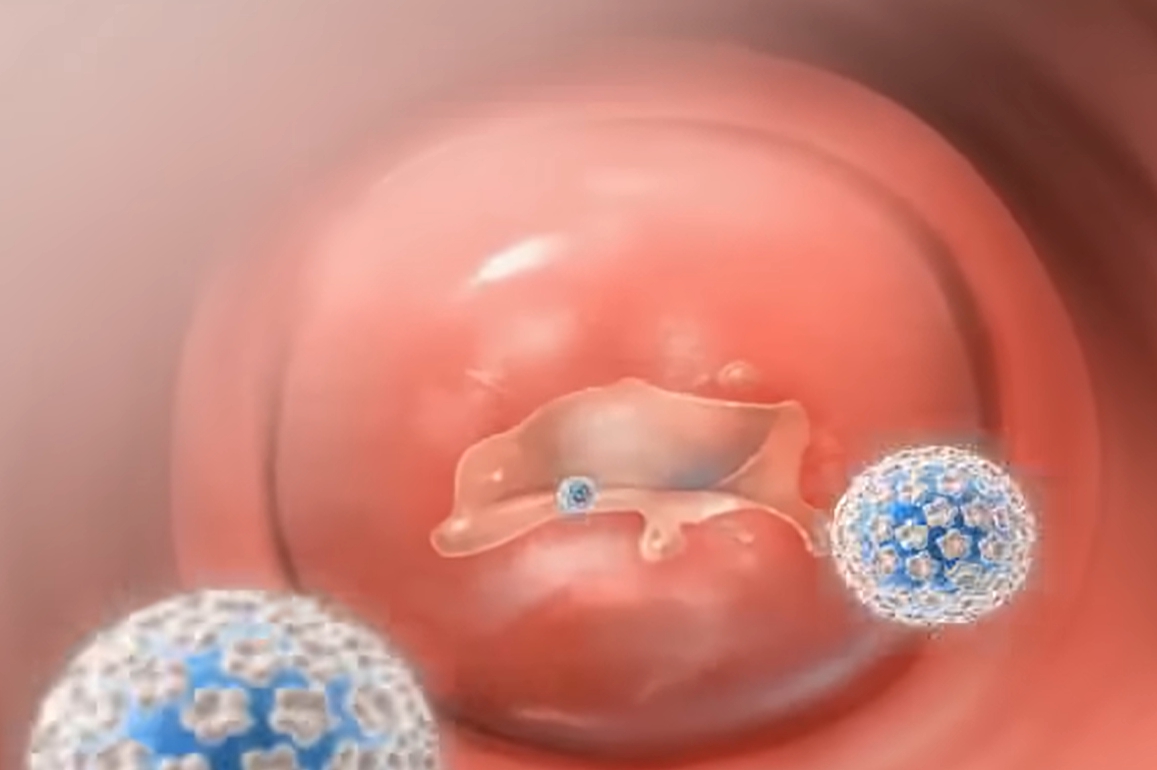 hpv 바이러스 증상